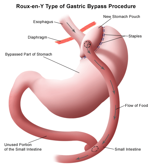 Roux-en-Y laparoscopic gastric bypass surgery
